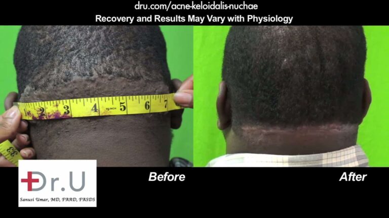 Dr U AKN Surgical Excision of Lesion Treatment Results