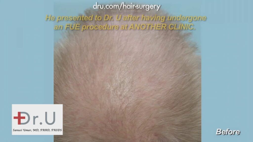 After his Indian FUE hair Transplant, He was still bald.
