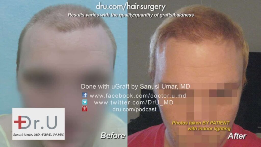 Crooked hairline repair - Before and After 