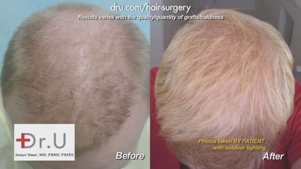 Before and after DrUGraft: fix asymmetric hairline