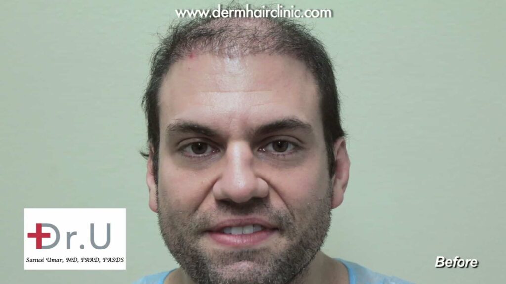 A before photo of a patient before his reparative hair transplant surgery from Dr. Umar.