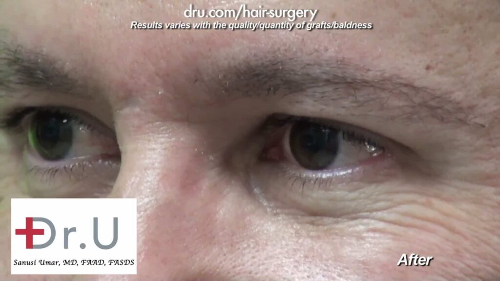 Male eyebrow restoration after Dr.Graft surgery. Eyebrow hair transplant cost depends on the number of grafts needed