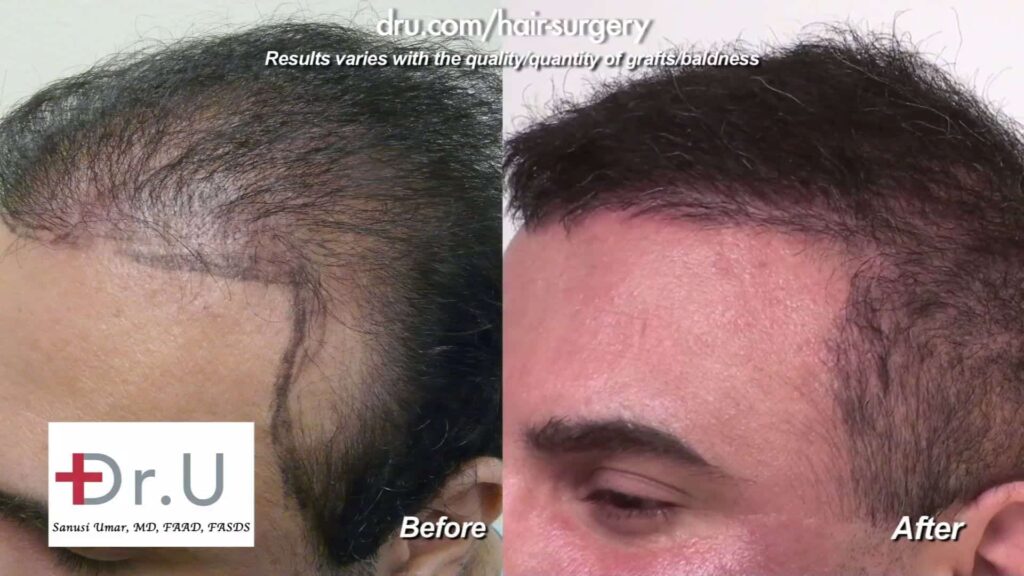 Hair transplant repair and scarring