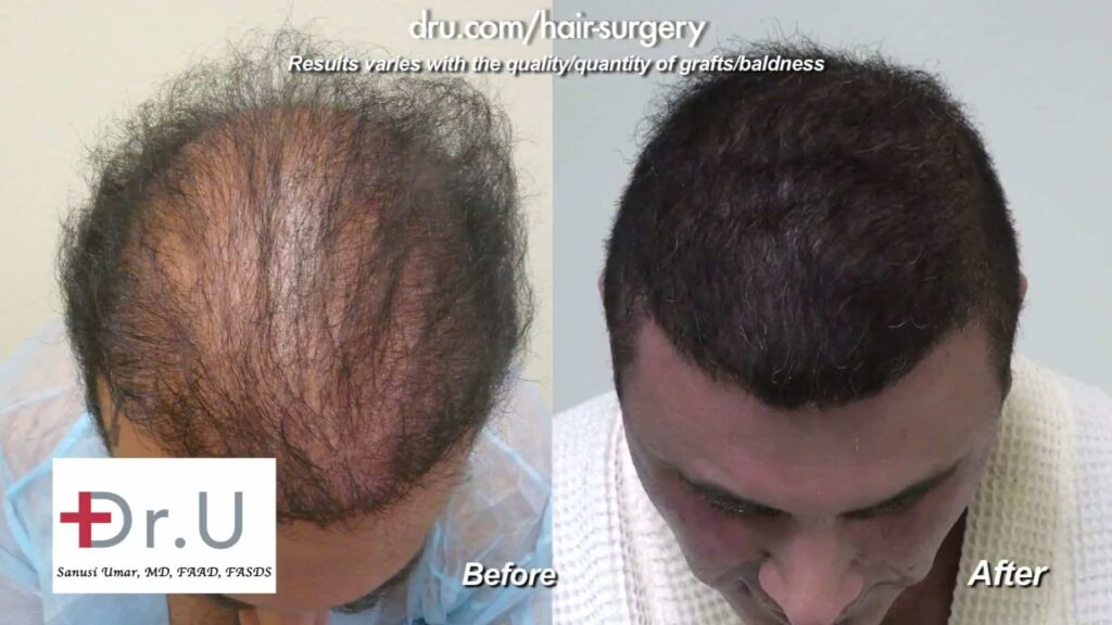 Does body hair transplant really work: The crown: much thicker coverage after Dr.UGraft
