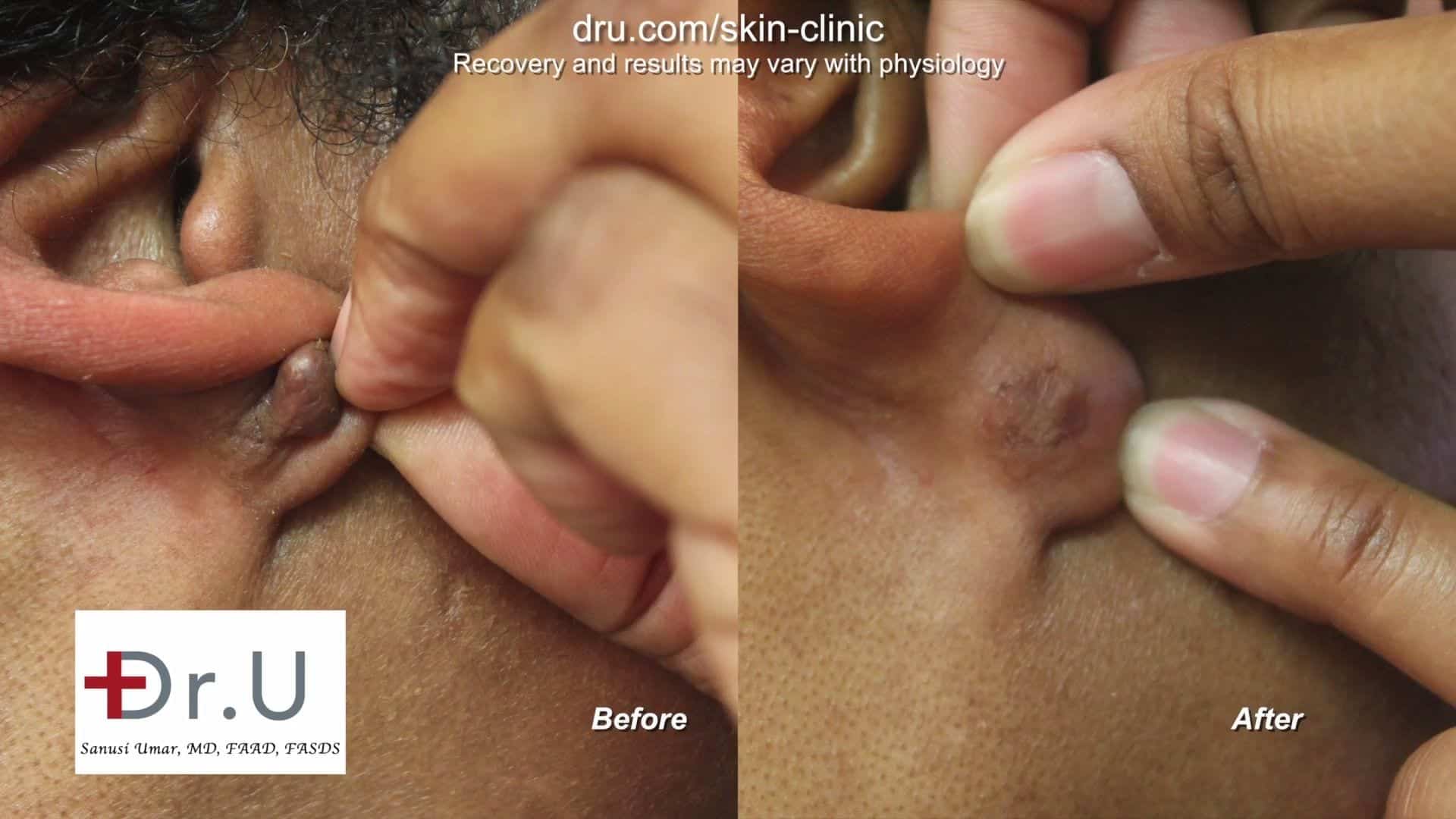  After receiving earlobe keloid removal treatment, this Los Angeles patient is left with a keloid free earlobe a year after the surgery.