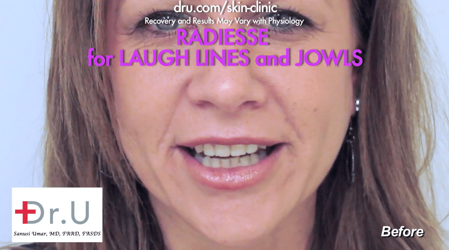 What are fillers? A smile line filler is another name for a laugh line filler. This patient received a laugh line reduction using dermal fillers.