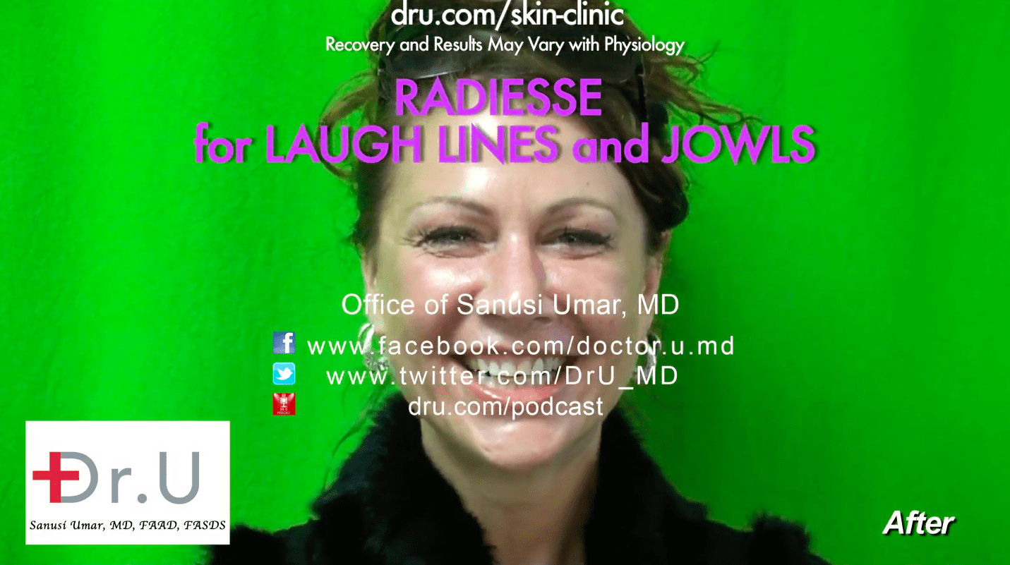 Radiesse treatment for laugh lines was a success.