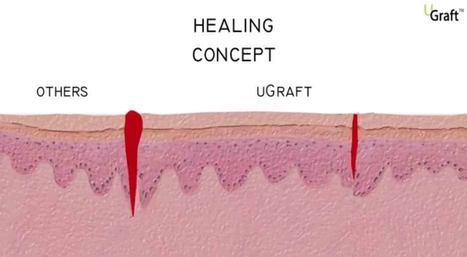 The Dr.UGraft system creates more minor wounds after healing than a generic FUE system.* The Dr.UGraft system creates more minor wounds after healing than a generic FUE system.*