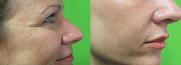 How to enhance lips: Lip fillers before and after