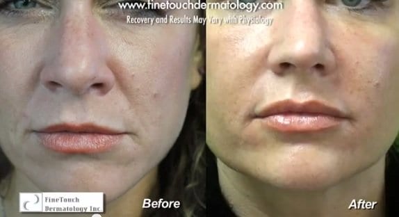 Radiesse Filling Laugh Lines Around Nose &amp; Mouth Simple injections of Radiesse into the nasolabial folds of this patient made a big difference in revitalizing the appearance of her lower face.*