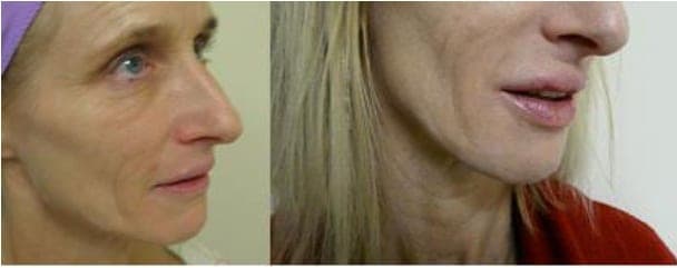 Natural lip enhancement Juvederm before and after