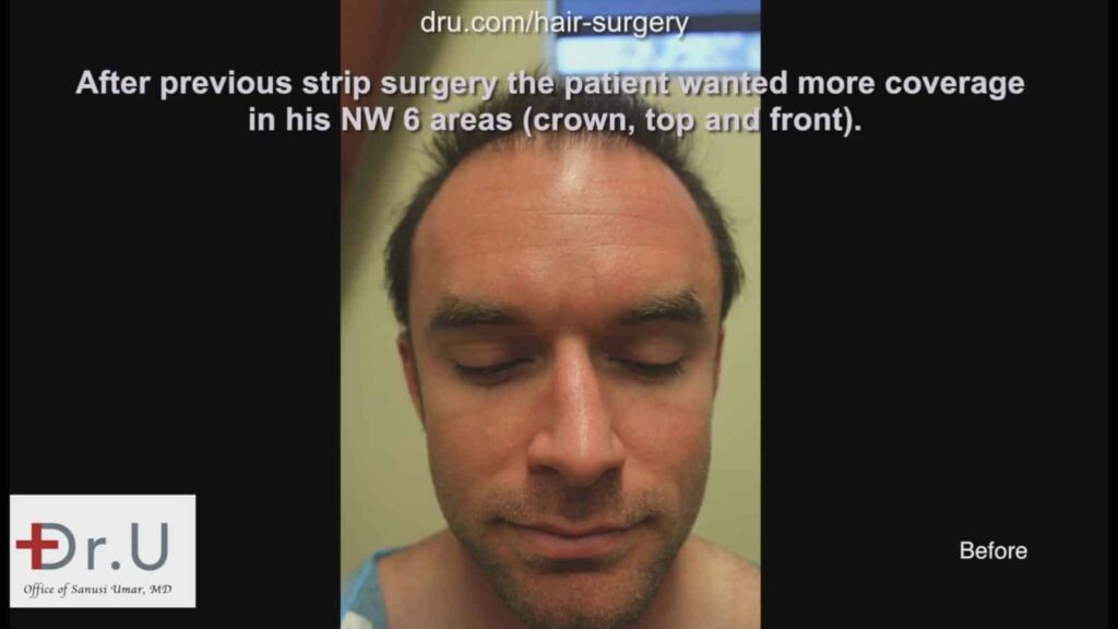 This Norwood 6 patient wanted to fix his poor strip surgery growth in the crown, top, front and hairline