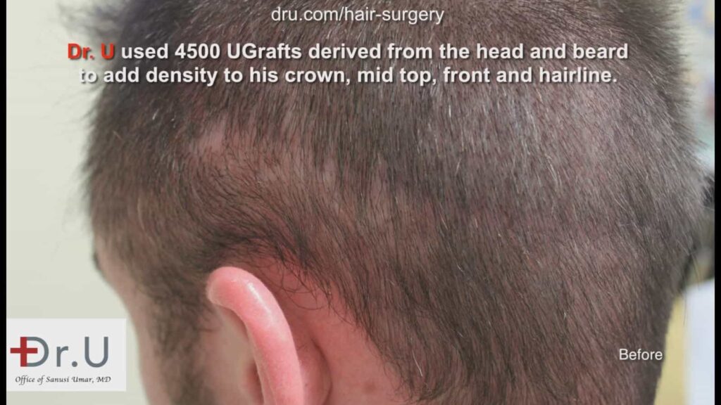 Photo before the patient's Dr.UGraft ™ procedure which illustrates the need for a strip scar concealment with FUE.