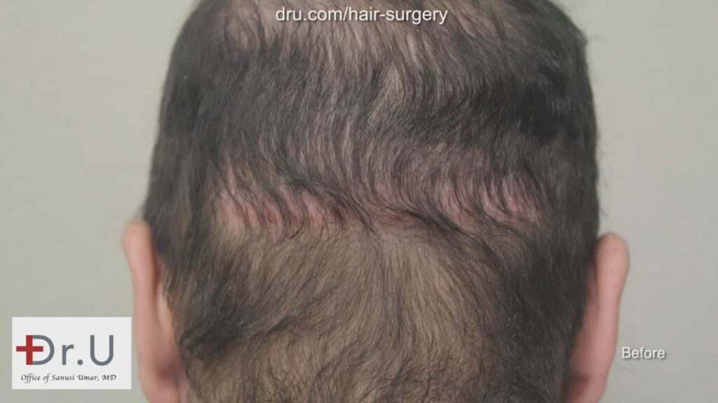 Photo showing patient before his hair transplant reparative surgery with Dr. Umar showing the linear hair restoration scar left behind from a previous procedure.