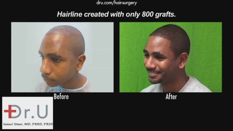 FUE for black patients can now produce reliable growth due to healthy, unharmed grafts, thanks to the advent of highly specialized tools like the Dr.UPunch Curl ™ designed to surgically treat hair loss in black men and women for successful hair transplant results