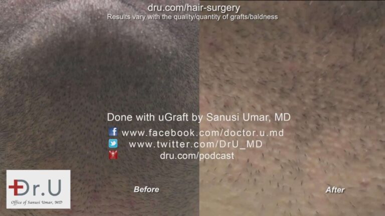 The Dr.UGraft™ left behind no visible hair restoration scar remains at the beard donor area