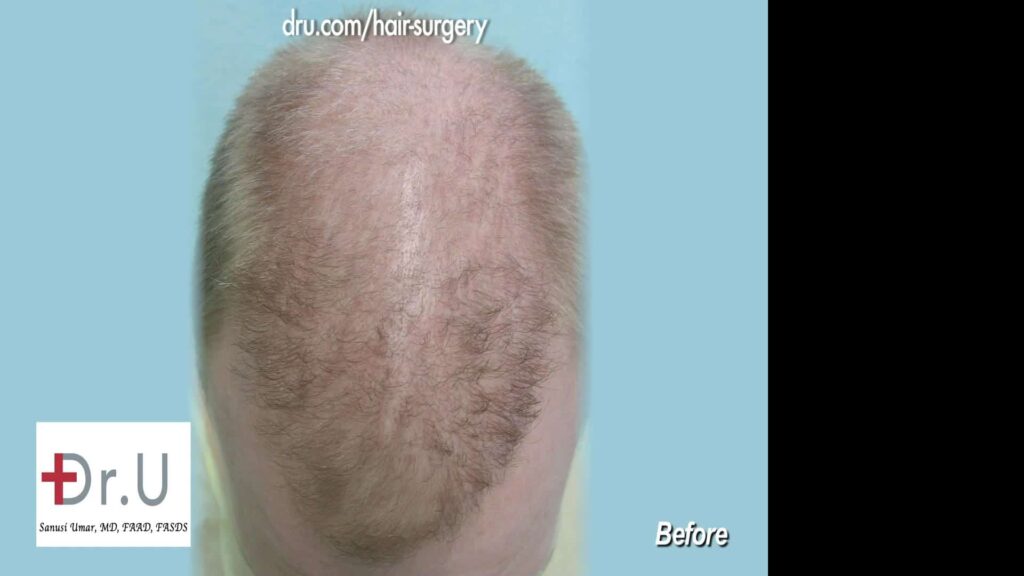 After an FUE hair transplant form a clinic in India, the patient was left with an asymmetric looking hairline