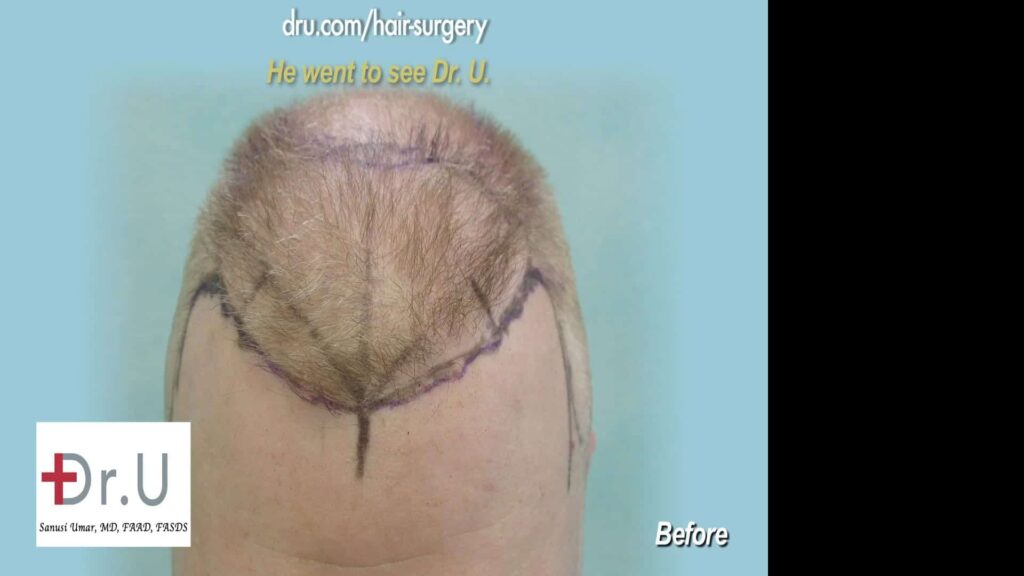 Dr U Uses the patients facial anatomic landmarks to construct hairline and temples in a manner that fixes the uneven hairline