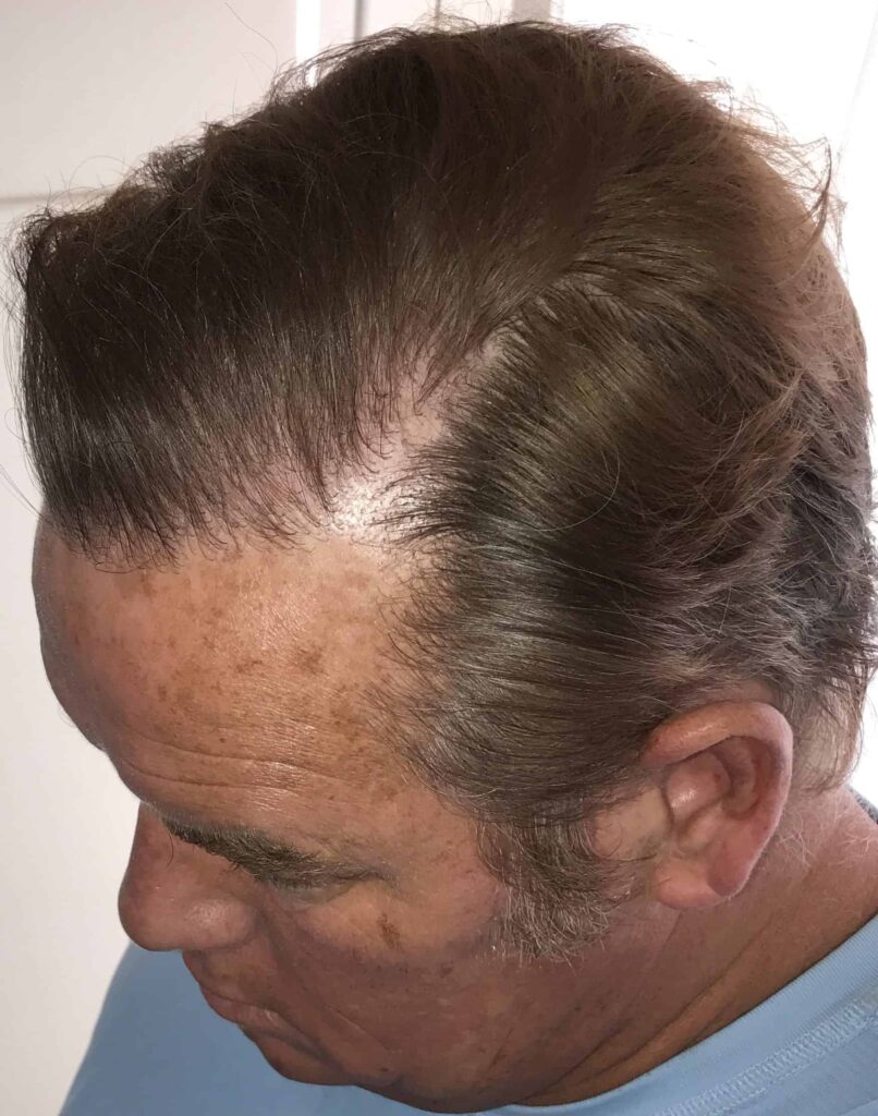 After treatment, the patient had no obvious signs of surgery, just a thick head of hair!
