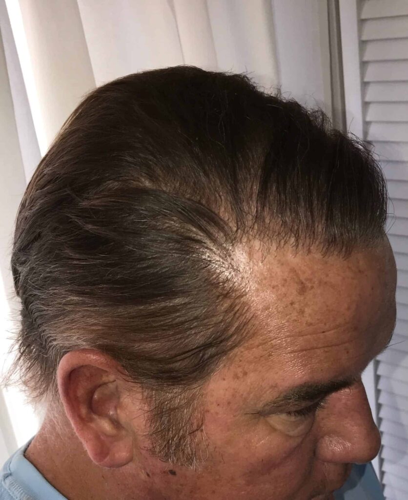 Even at the hairline and temple area, results of the Dr.UGraft look totally natural