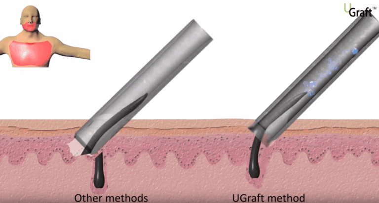 How the Dr.UPunch i technology extracts navigates angled hair compared to regular, straight FUE punches