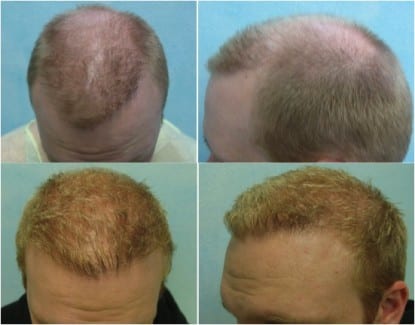How to fix uneven hairline with the DrUGraft