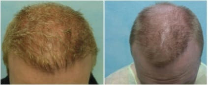 Fix young hair transplant - Before and After DrUGraft