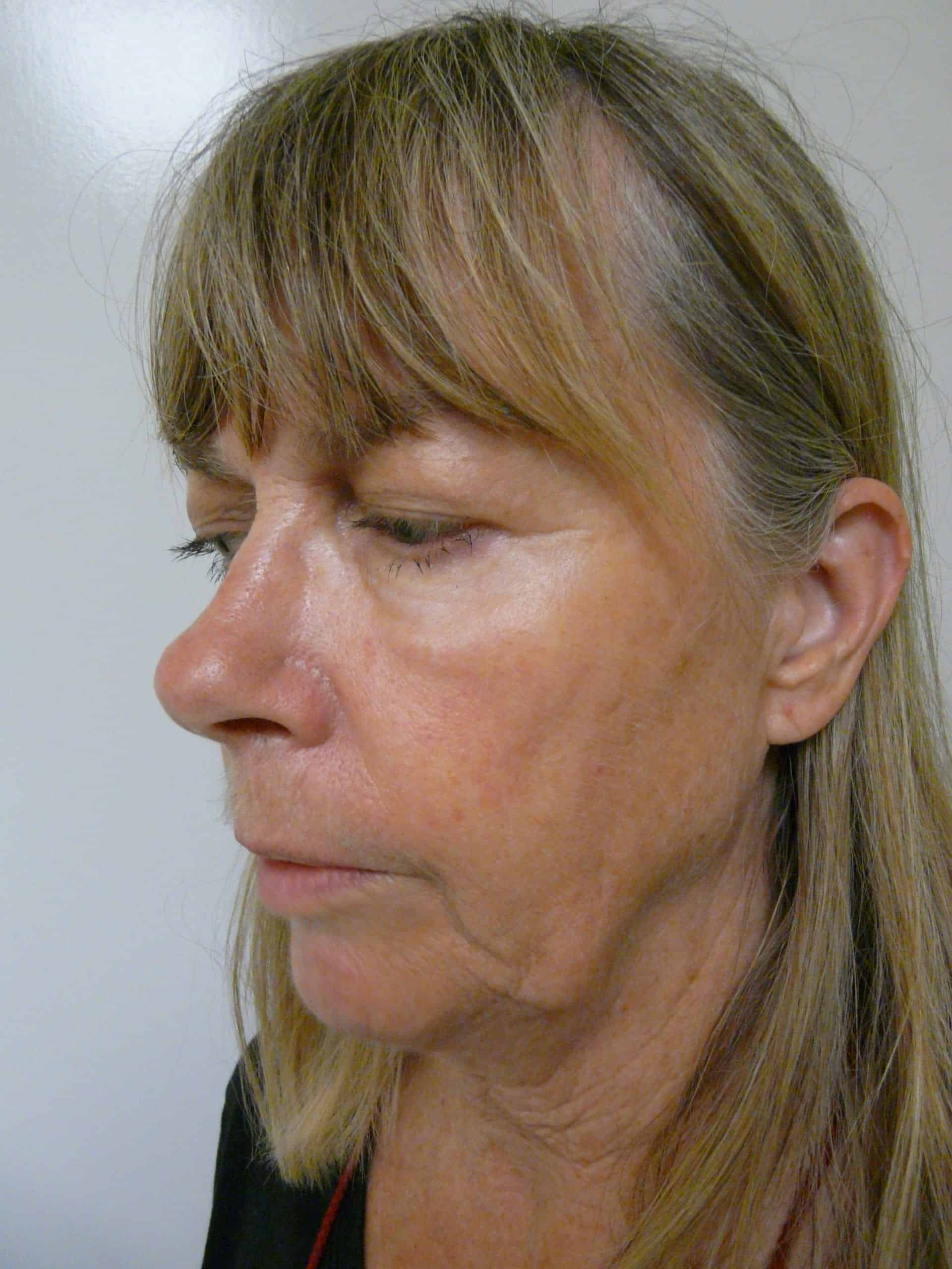 The patient’s picture before Dr. U’s jowl lift without surgery.