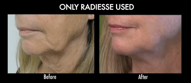 No Surgery Face Lift also known as Liquid facelift before and after: How to get a more defined lower face without surgery.