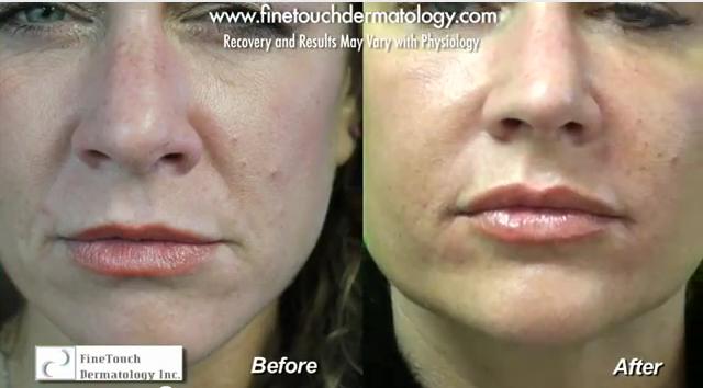 Face lift without surgery results.