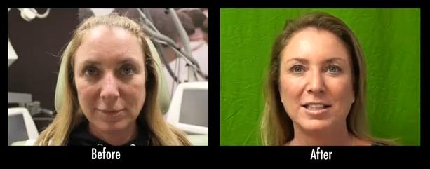 This patient used facial sculpting injections for her non invasive facial contouring.
