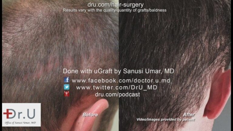 Before and after photos show how the patient's abundant donor graft pool was able to achieve a remarkable strip scar concealment with FUE, using the Dr. UPunch intelligent