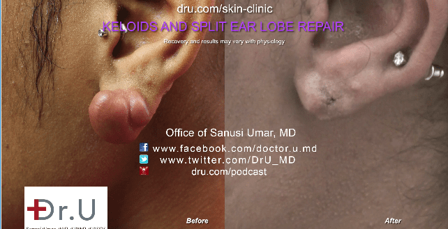 Successful split ear repair surgery in Los Angeles