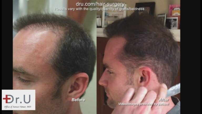 The use of beard hair provided enough resources to repair bad strip surgery results in the areas of depleted hair an the scarring itself