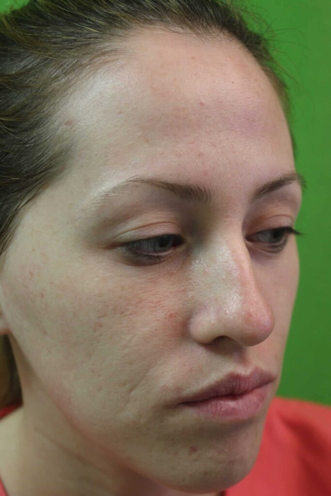 A young patient of Dr U in Manhattan Beach Los Angeles who presented with complaint of laugh line wrinkles