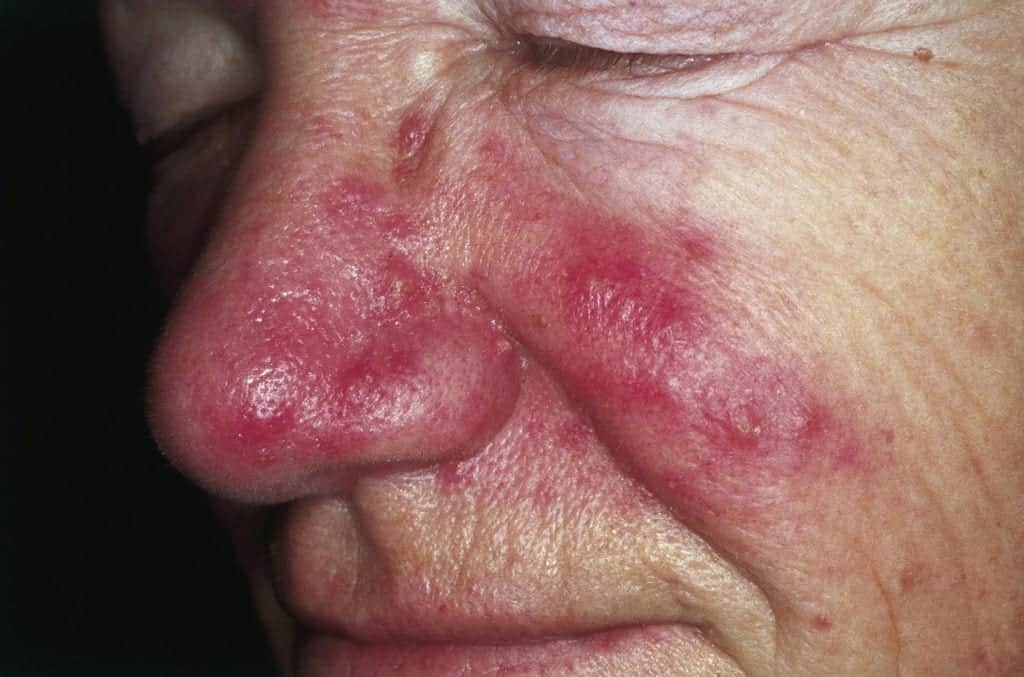 Rosacea is a common skin condition that appears in the form of redness and bumps on the skin. Continue reading this article for more rosacea information and red face treatment options with Dr. U. Rosacea is a common skin condition that appears in the form of redness and bumps on the skin. Continue reading this article for more rosacea information and red face treatment options with Dr. U.