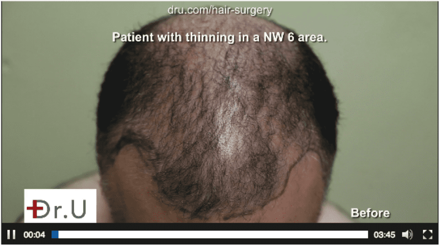 Before Dr. Umar completed his chest hair to head transplant for Canadian