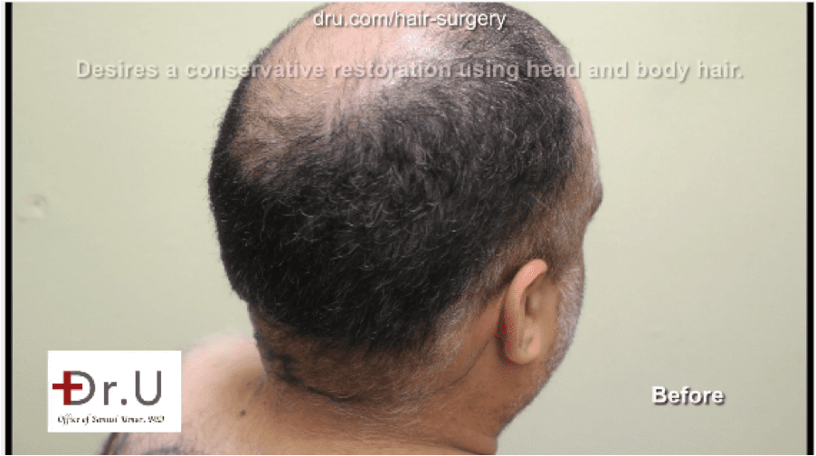 Body Hair transplant for canadians are available in LA by Dr. Umar.