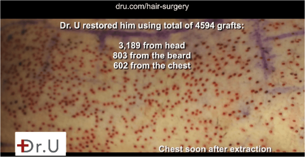 The patient used 602 grafts from his chest hair to head transplant.