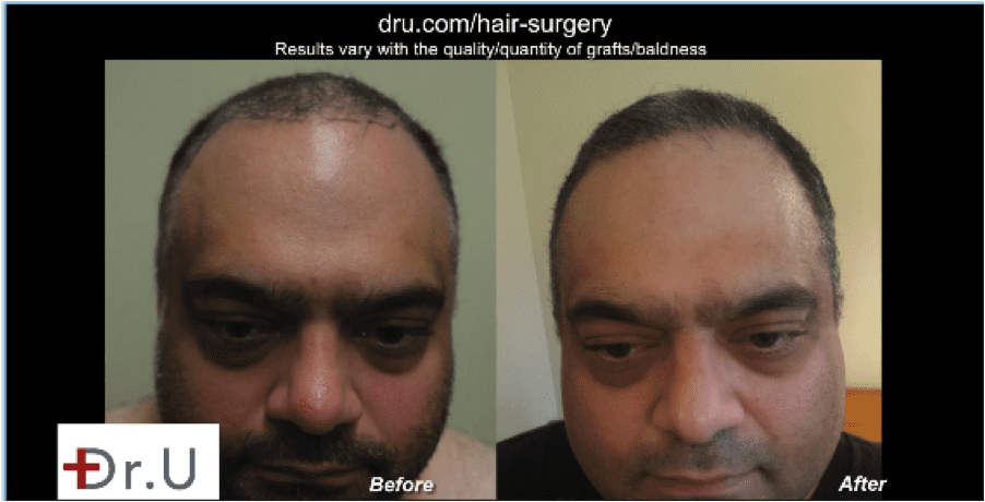 This patient is very pleased with his Natural hair transplant results using DrUGraft.*