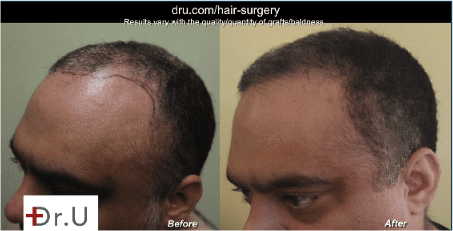Are you interested in a body hair transplant for canadians? Dr. U in Manhattan Beach is here to help.*