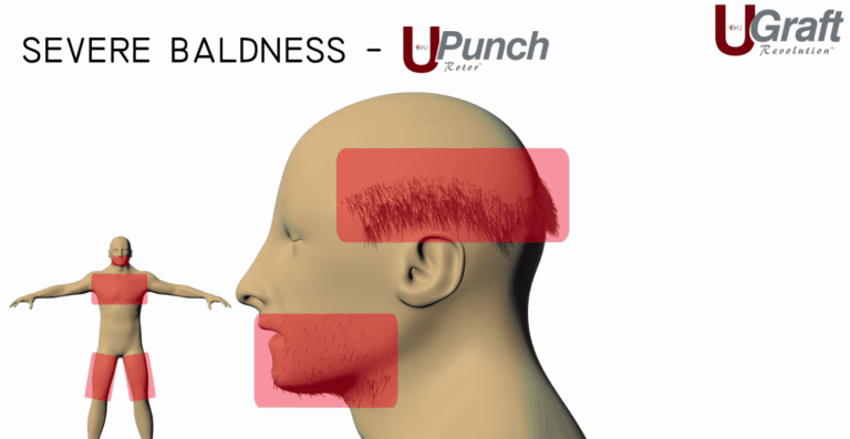 Dr.UGraft ™ technology is able to pull hair from the beard, head and body to create fuller coverage on the top the head.