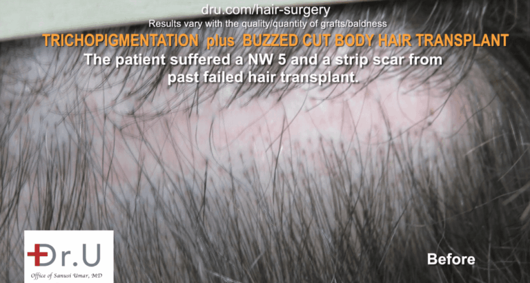 The patient before Dr.UGraft FUE Plus SMP.