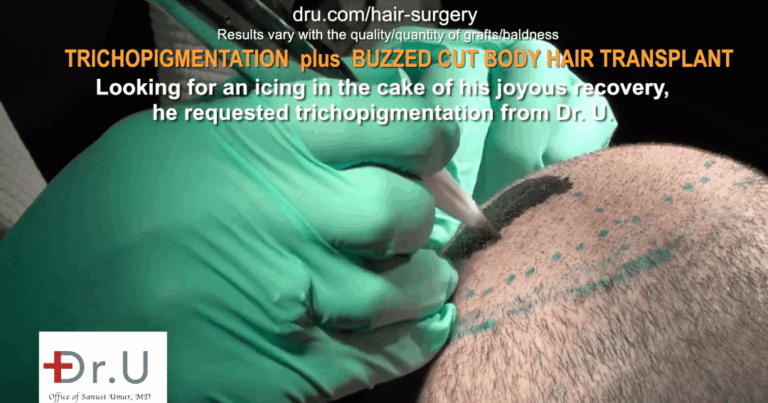 The patient undergoes body hair transplant and SMP combo.