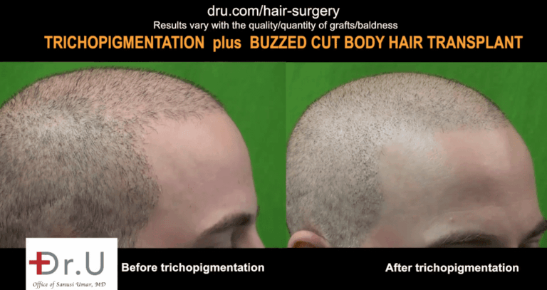 Incredible results of SMP after FUE hair transplant.