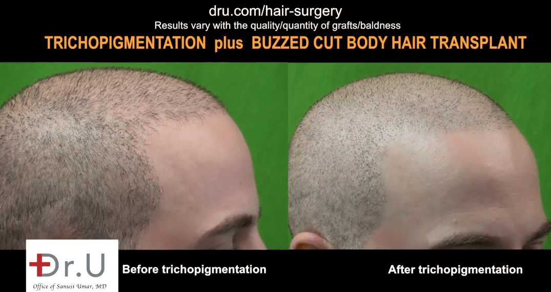Trichopigmentation was used to create the appearance of greater density for this patient. Here are before and after photos where the look of an even greater hair transplant density was achieved
