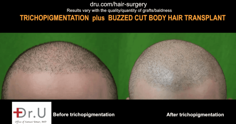 SMP affect hair transplant success