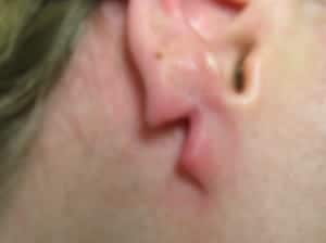 When an earlobe splits it will start to heal the two separate halves. This can create very noticeable damage, such is the case for this patient.