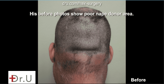 After a shave test this patient proved to have a poor nape donor area.