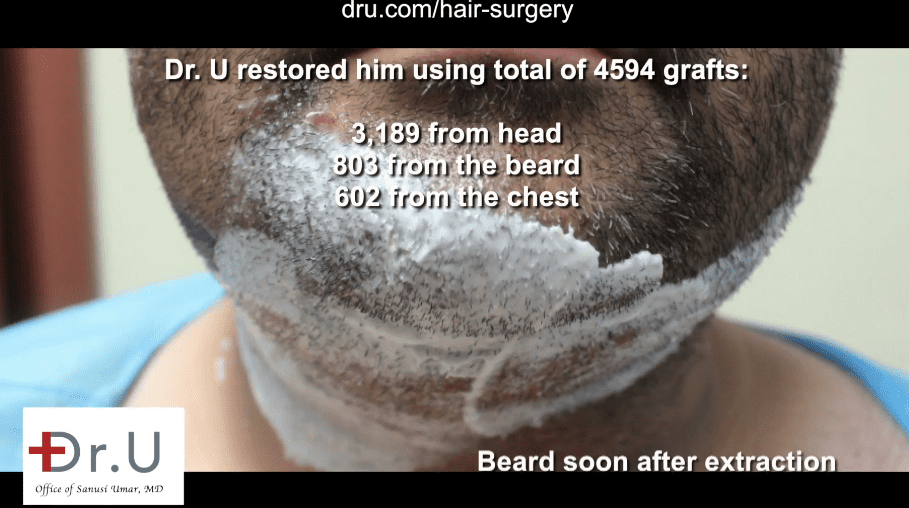 The patients beard donor area shortly after his extraction.